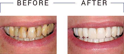 The image displays a before and after comparison of dental teeth whitening, showcasing the difference between yellowed teeth and brightened, clean teeth.